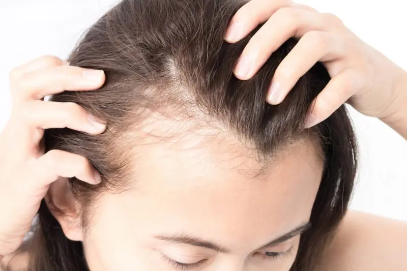 Baldness Treatment – Effective Solutions for Hair Loss